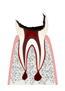 【C4】歯の根(歯質)が失われた歯