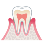 歯周病の進行（軽度）
