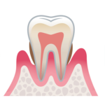 歯周病の進行（中等度）